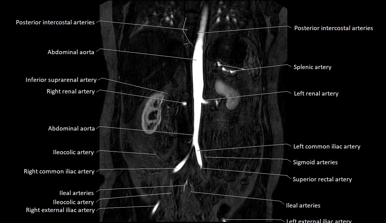 MRA Abdomen coronal anatomy image 23.webp